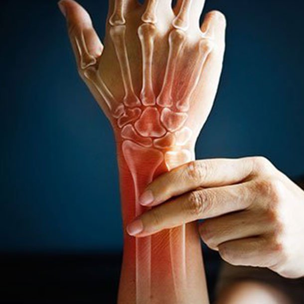rheumatoid arthritis a kezén
