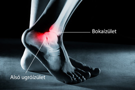 hogyan kezelik a boka artritiszét