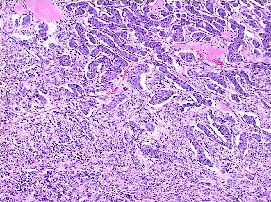 adenocarcinoma with neuroendocrine differentiation pathology outlines