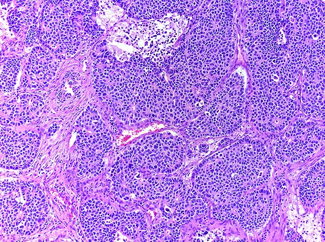 adenocarcinoma with neuroendocrine differentiation pathology outlines