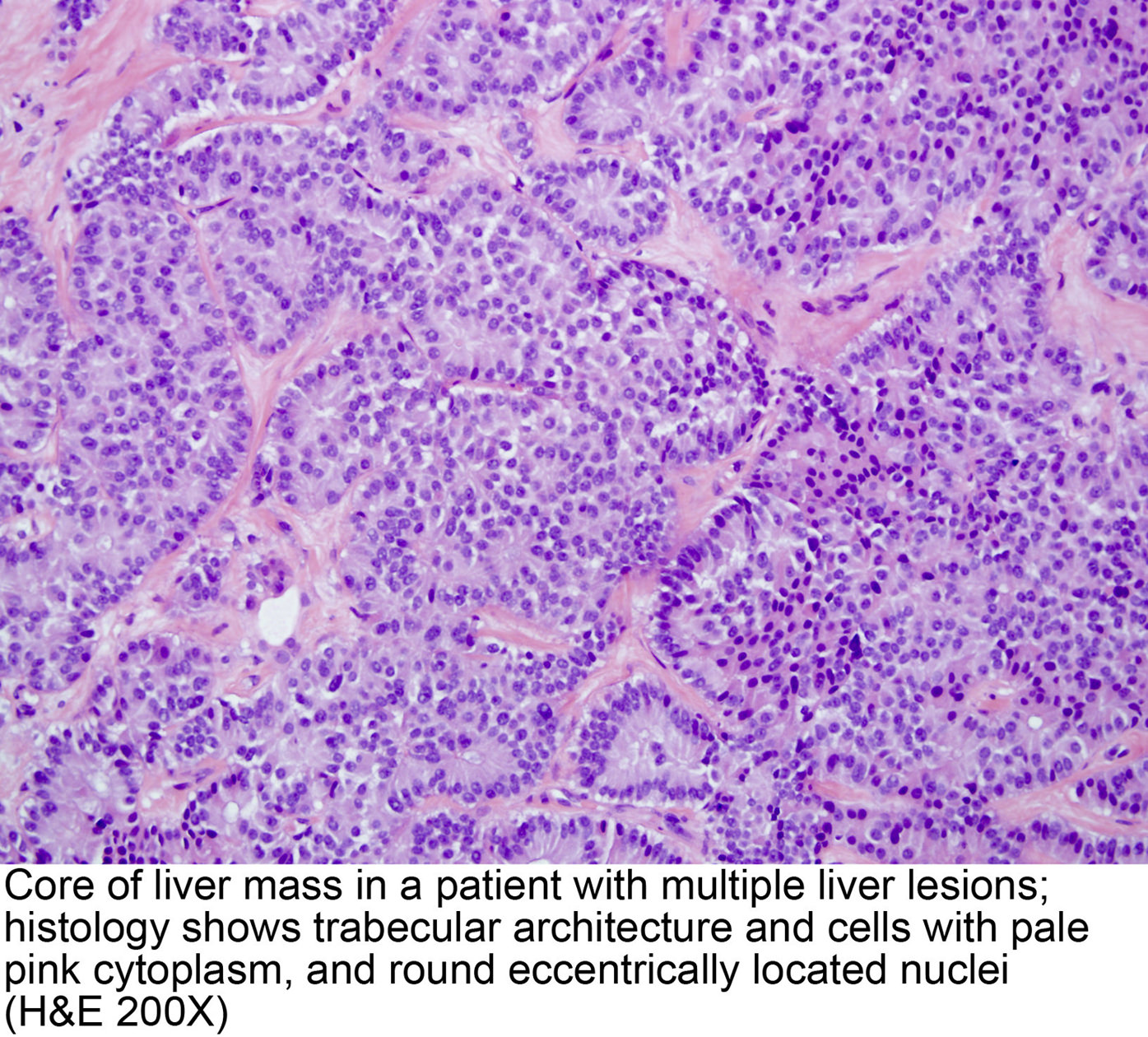 adenocarcinoma with neuroendocrine differentiation pathology outlines