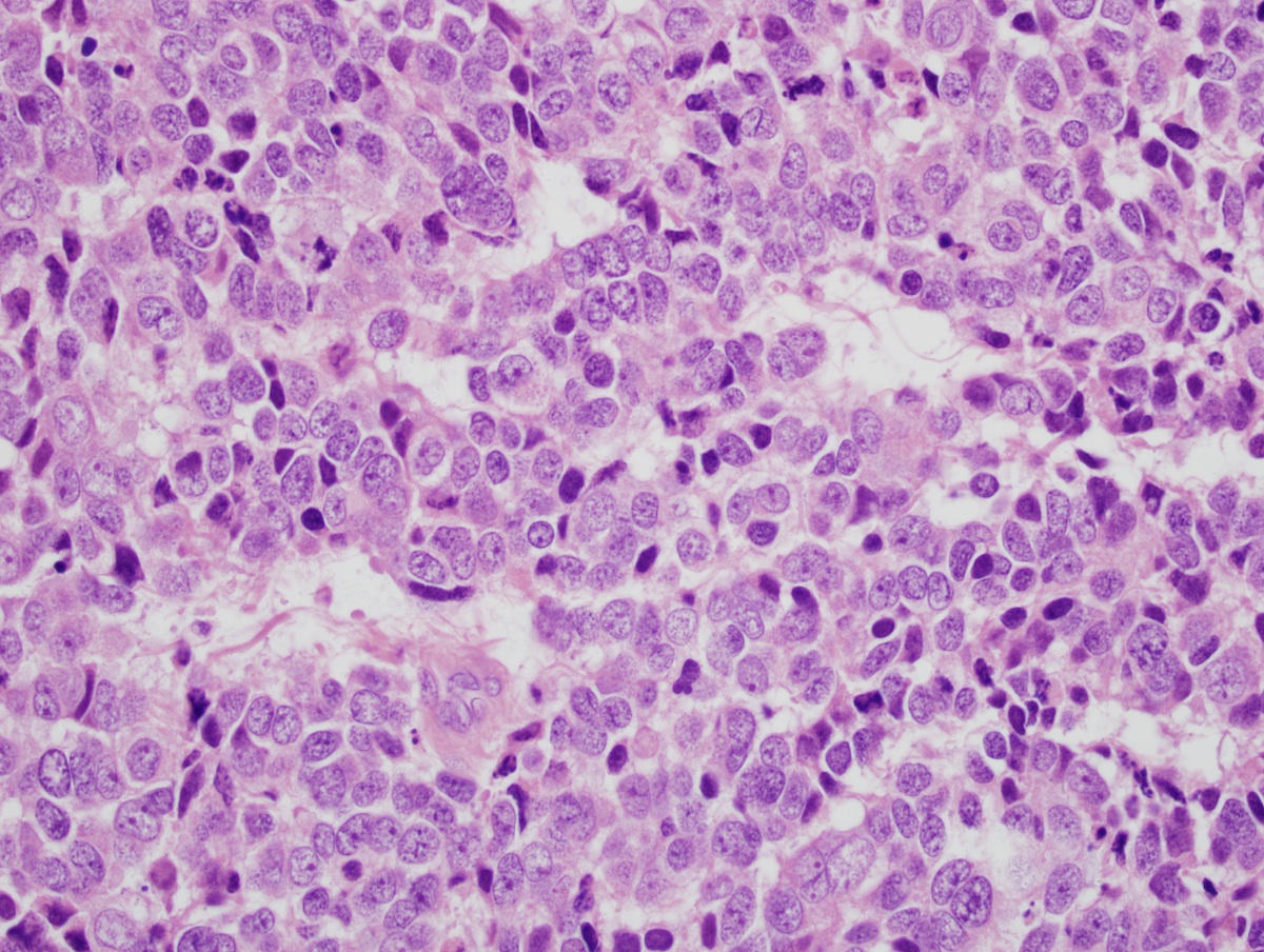 adenocarcinoma with neuroendocrine differentiation pathology outlines