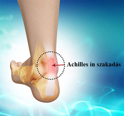 achilles ín szakadás tünetei