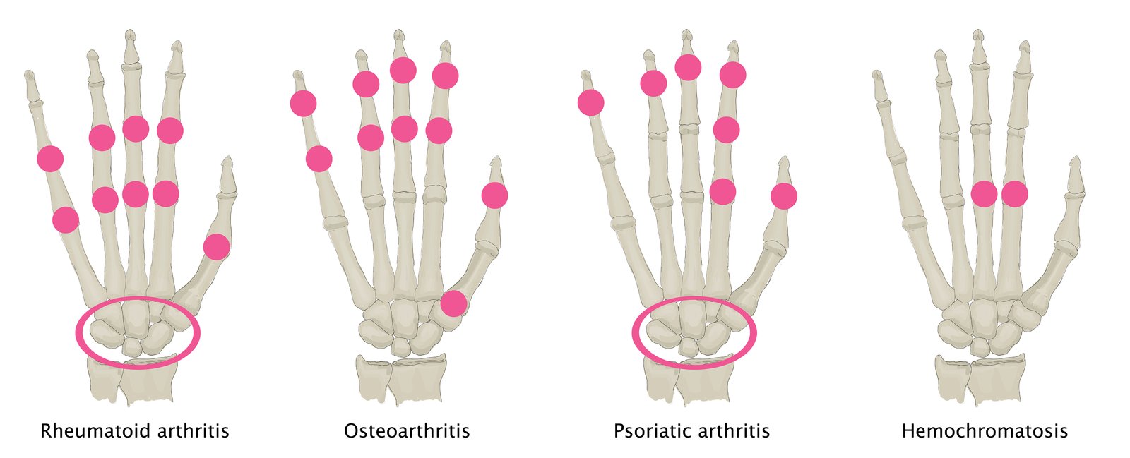 rheuma arthritis amboss)