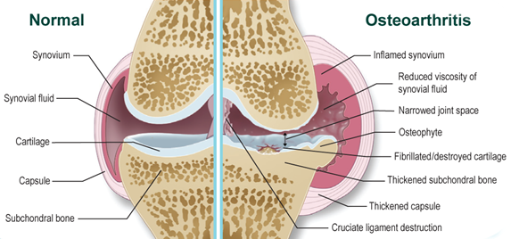 Az ízületek polyosteoarthritisének kezelése