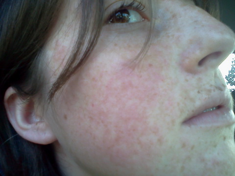 Lupus erythematosus ízületi fájdalom - Minden ízület fáj, mit kell tenni