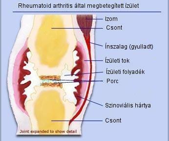 10 jó tanács ízületi fájdalom esetére - Egészségtüköfoldesjozsietterme.hu