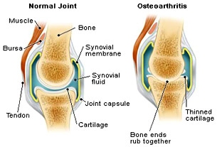 osteoarthritis aktív)