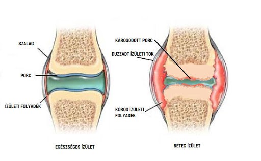 térd degeneratív osteoarthrosis 2 fokos kezelése)