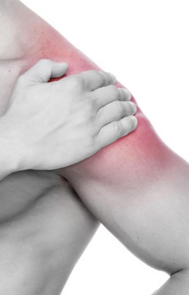 Impingement szindróma