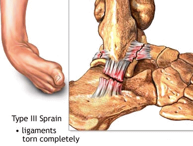 boka ligamentum sérülése)
