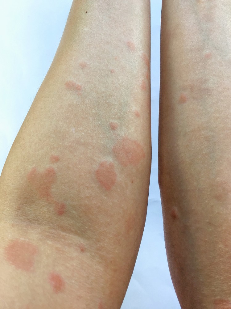 szisztémás lupus erythematosus kötőszöveti betegség)