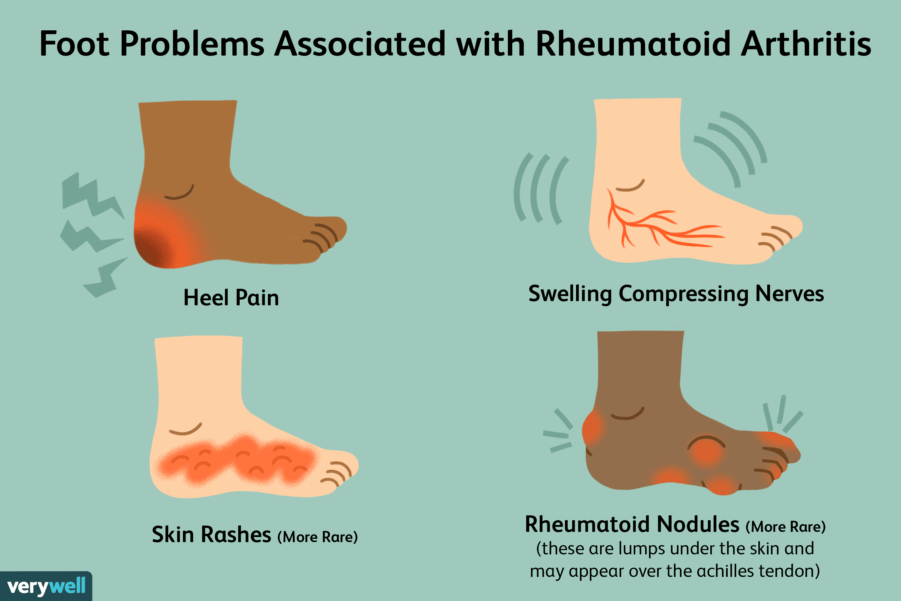 rheumatoid arthritis early stages