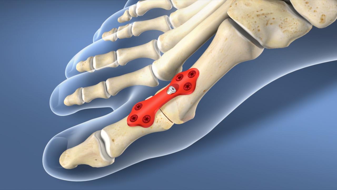 1st metatarsophalangeal joint osteoarthritis icd 10)