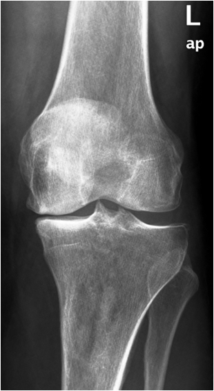 ízületi betegség osteomyelitis