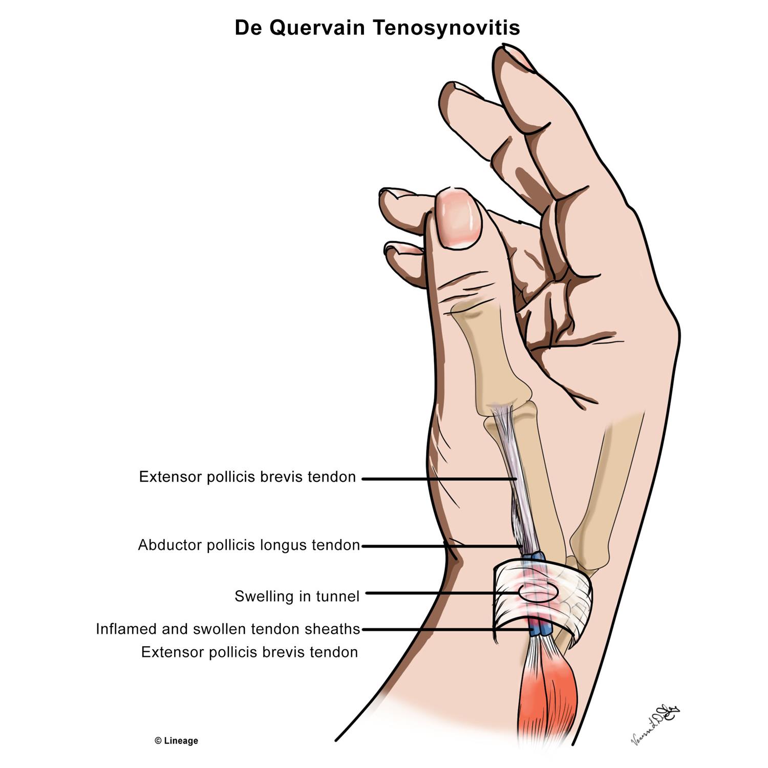 de quervain syndrome test)