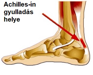 achilles gyulladás gyógyítása