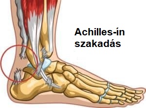 achilles gyulladás gyógyítása)
