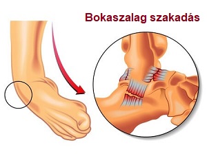 Bokaszalag-szakadás - Gyógyulás időtartama