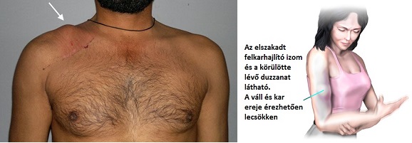 csípőtörés elmozdító kezeléssel