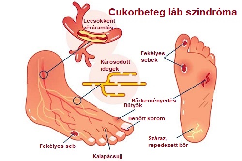 térdízületi fájdalom cukorbetegség
