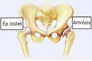 artrózis torna kezelés autoimmun polyarthritis