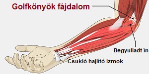 könyökfájdalom és kezelés)