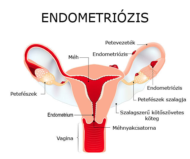 Stressz is okozhatja a kismedencei fájdalom szindrómát