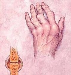 ízületi rheumatoid arthritis