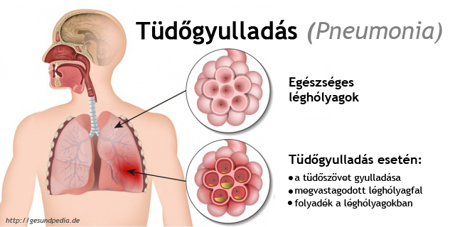 térd őssejt diffúz kötőszöveti betegség jelei