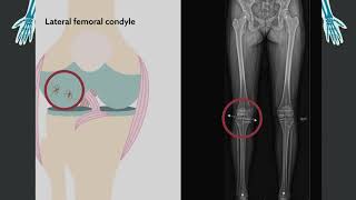 a lábak ízületeinek osteochondrosis tünetei)