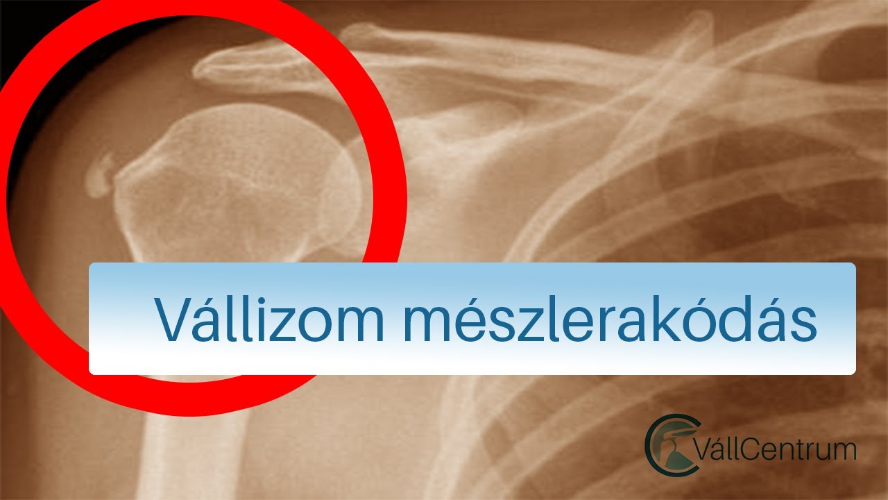 váll meszesedés gyógyítása)