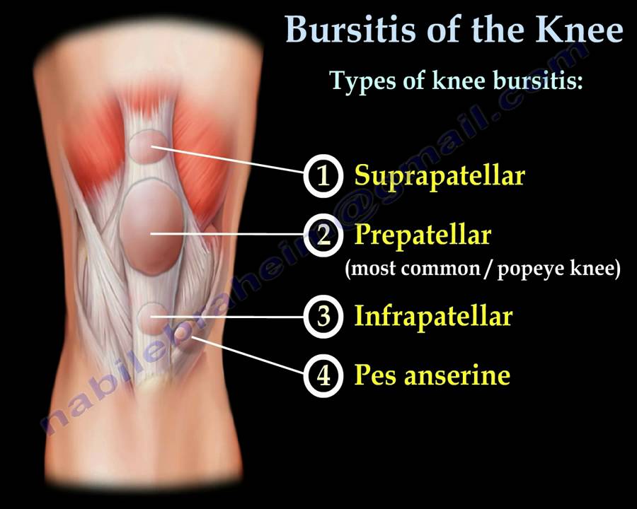poszt traumás bursitis a térdízület kezelésében)