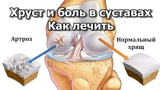 vásároljon glukózamint és kondroitint egy gyógyszertárban)