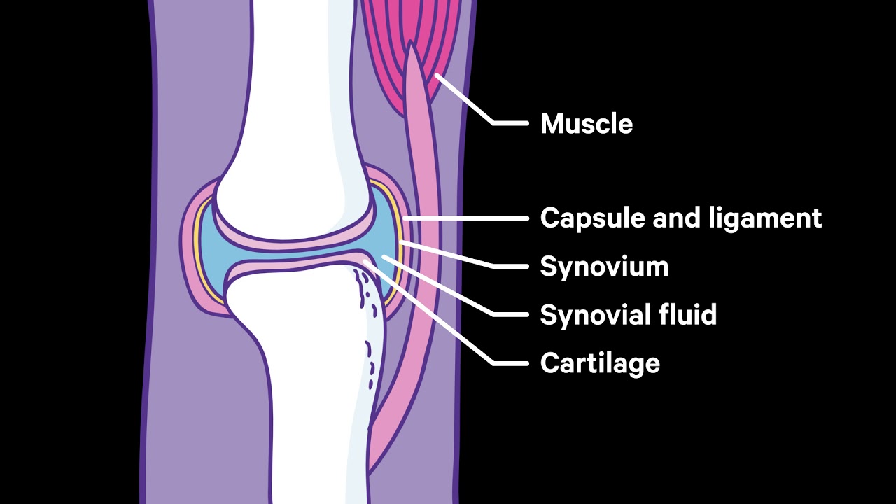 Rheumatoid arthritis