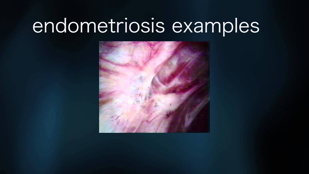 Endometriosis fájdalom a csípőízületben A csípőfájdalom okai, betegségei, tünetei