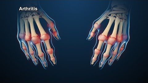 a fiatalkori rheumatoid arthritis kezelése)