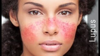 ízületi fájdalom lupus erythematosus kezeléssel