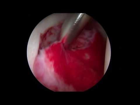 kenőcsök térd osteochondrozisához)