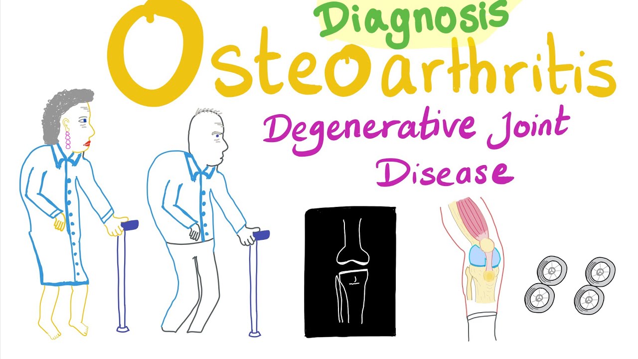 térdízület kezelési kódja osteoarthritis)