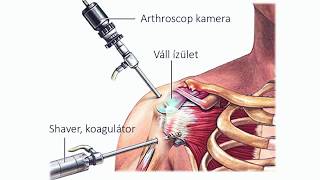 a vállízület osteoarthrosisának kezelési módszerei