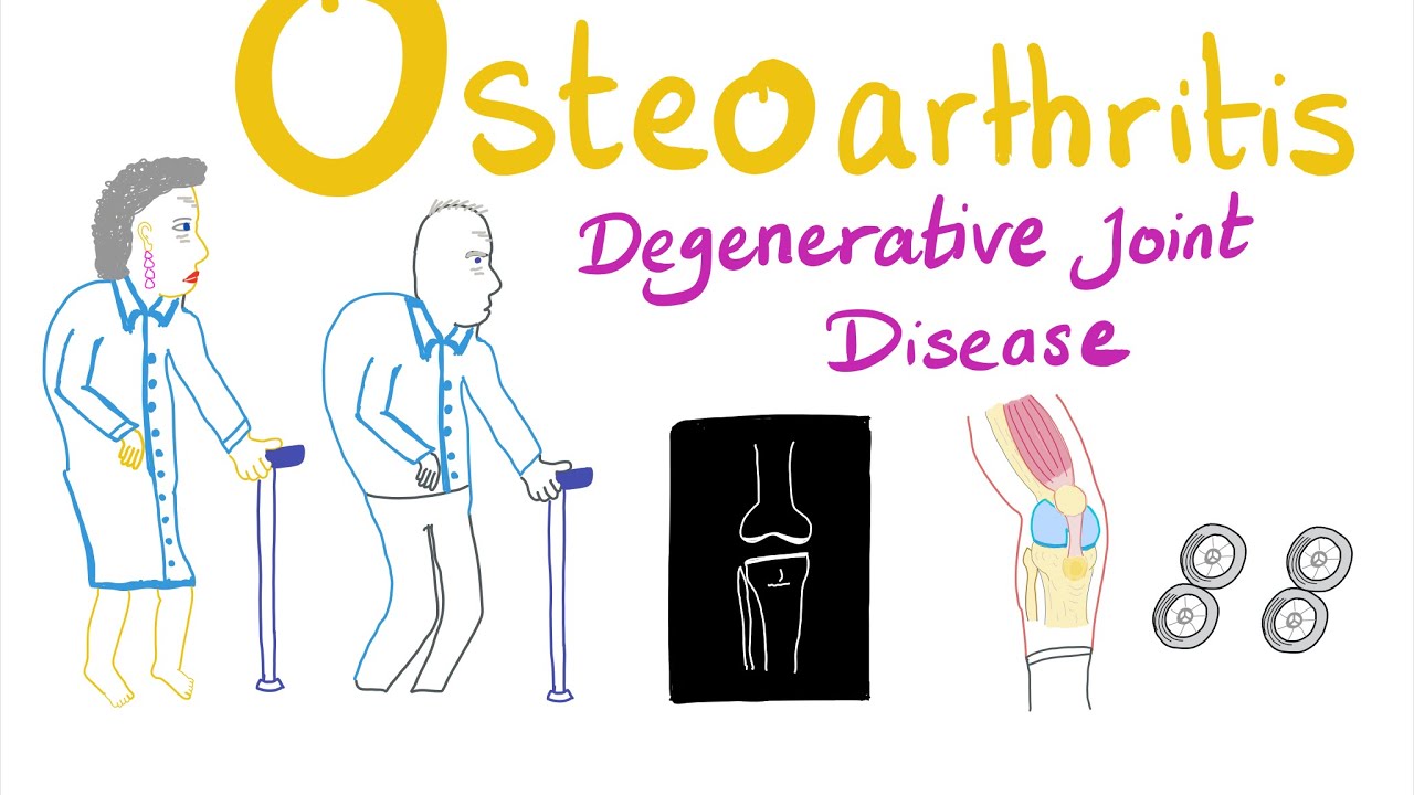 a boka ízületének 2 fokozatú kezelés deformáló osteoarthrosis ja