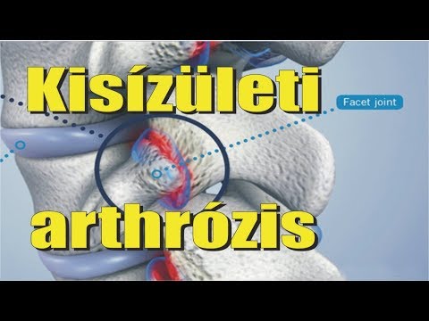 Kenőcsök minden osteochondrozishoz, alkalmazási körét