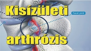 mágnesek a csípőfájdalomhoz