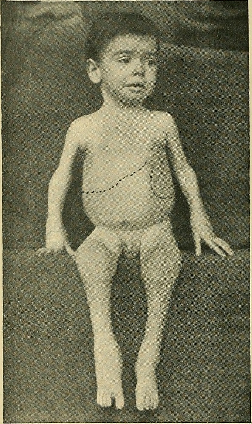 fiatalkori rheumatoid arthritis ízületi gyulladással)