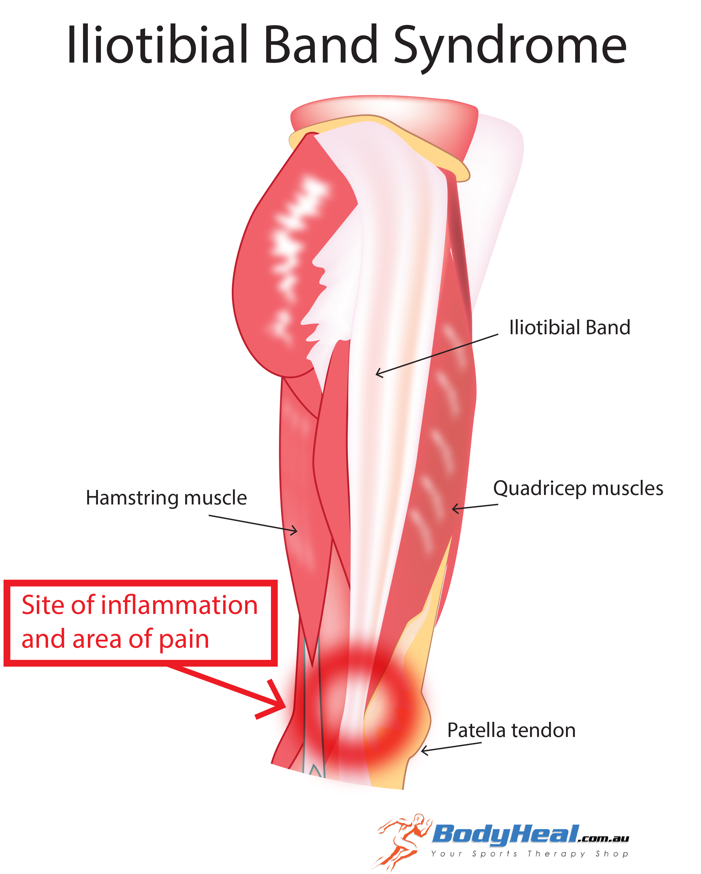 iliotibial tract pain