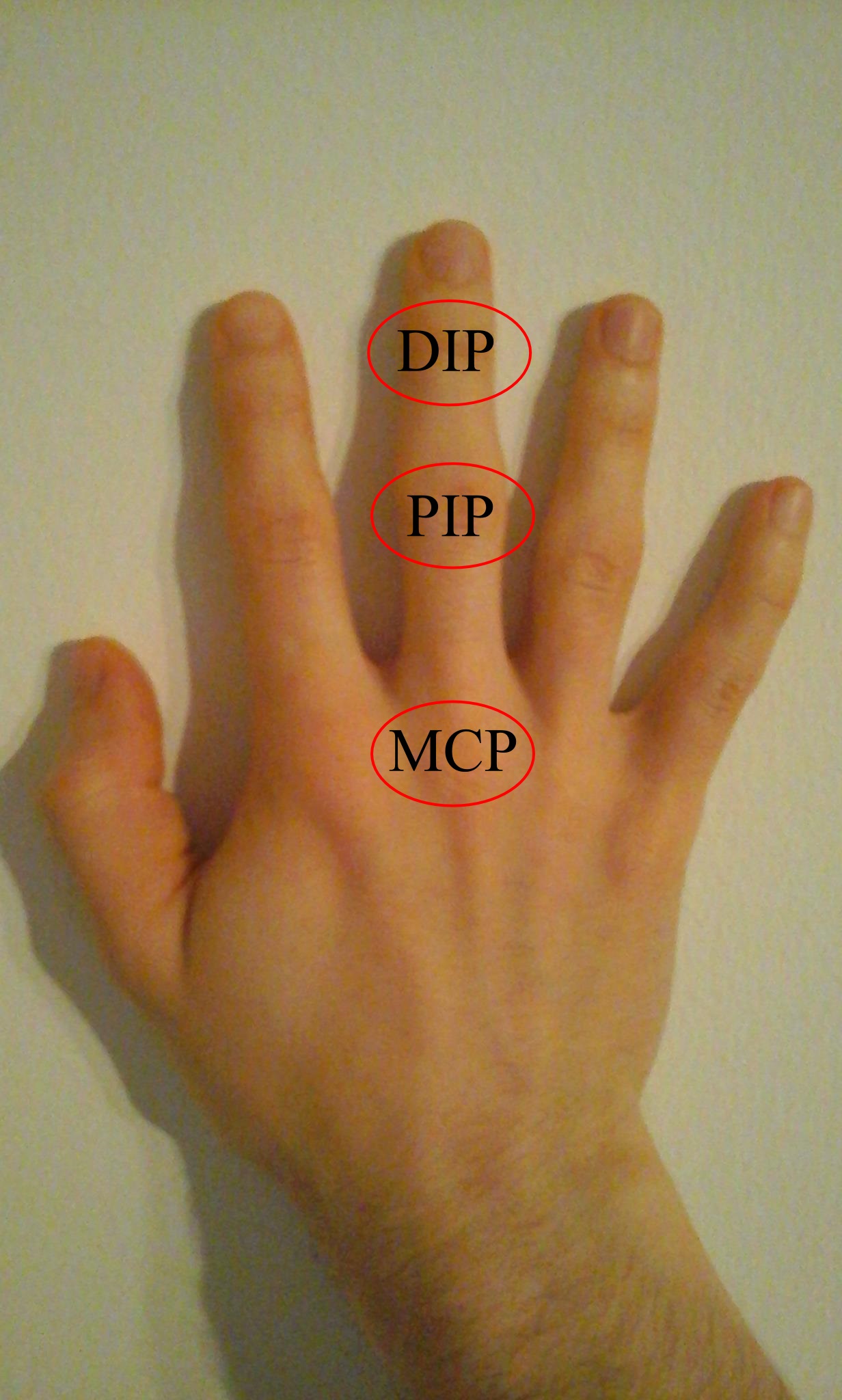 rheumatoid arthritis ízületi gyulladása