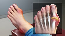 psoriatic arthritis wiki