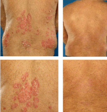 psoriatic arthritis wiki
