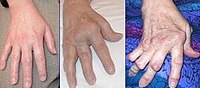 A rheumatoid arthritis kezelése